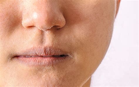 Dry Skin Around The Nose Causes Treatment And Prevention Vedix