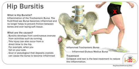 Hip Joint Bursitis Tendinitis Causes Signs Symptoms Diagnosis Sexiz Pix