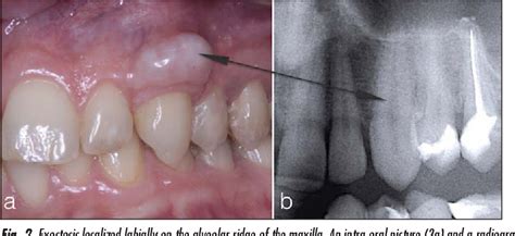 Pdf Exostoses Of Jaw Bones Aetiology Morphology And Treatment Of