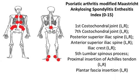 Case Report A Psoriatic Arthritis Patient With Dactylitis And Enthesitis