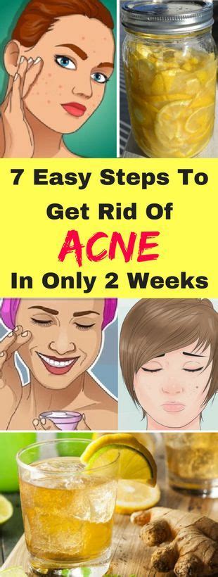 7 Easy Steps To Get Rid Of Acne In Only 2 Weeks Healthycatcher