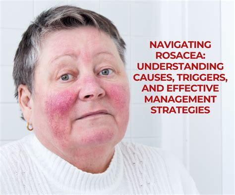 Navigating Rosacea Understanding Causes Triggers And Effective Management Strategies