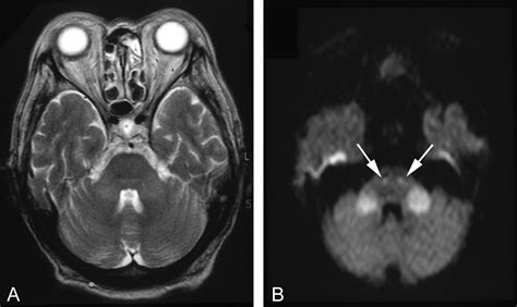 Mr Features Of Diseases Involving Bilateral Middle Cerebellar Peduncles
