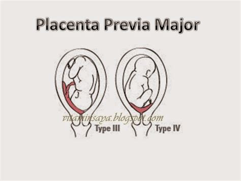 Learn about the risks and more here. Plasenta Previa: Komplikasi Kehamilan Yang Wajib Anda ...