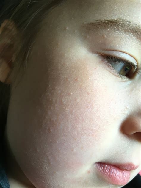 Help With Bumps On Face Eczema Gbcn