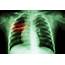 Lung Disease Increasingly Detected In Children With Systemic Juvenile 