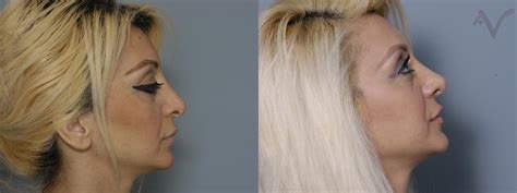 Revision Rhinoplasty Before And After Pictures Case 9 Los Angeles Ca