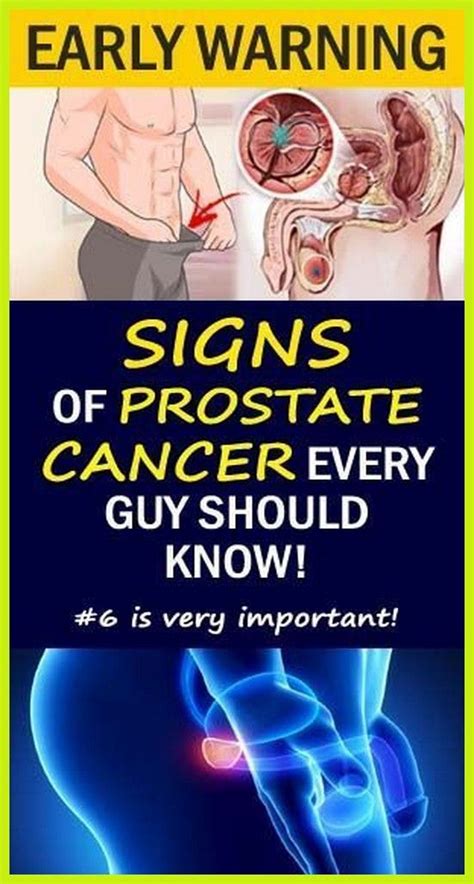 Early Warning Signs Of Prostate Cancer That Every Guy Needs To Know Do Not Ignore