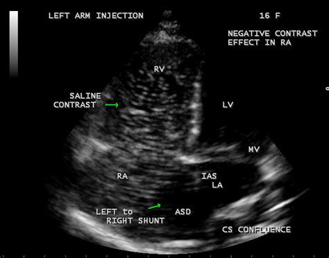 Bubble Study Showing The Negative Contrast Effect In The Right Atrium