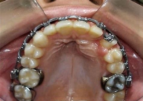 Pin By John Beeson On Orthodontic Braces Orthodontics Braces Orthodontics Braces