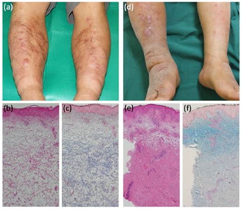 The Course Of The Patients Skin Lesions And Skin Specimen From The