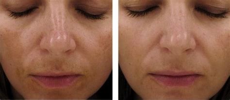 Chemical Peels Specialist Skin Clinic Nuriss