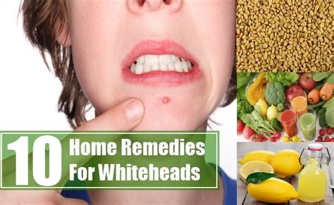 10 Home Remedies For Whiteheads Search Home Remedy