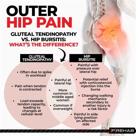 Hip Bursitis Versus Gluteal Tendinopathy 𝗣 𝗥𝗲𝗵𝗮𝗯