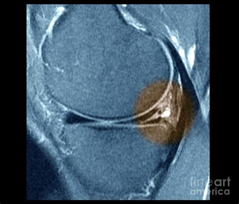 Knee Meniscus Injury Photograph By Zephyrscience Photo Library