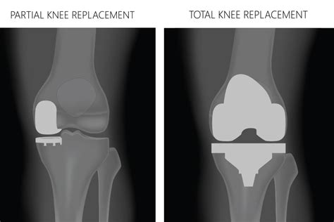 Partial Knee Replacement Vs Total Knee Replacement