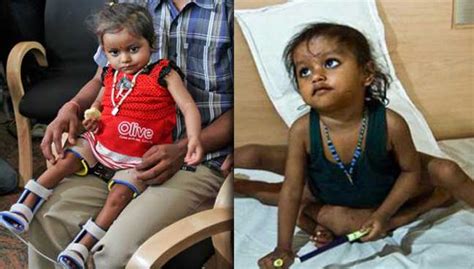 Baby With Eight Limbs Gets New Lease On Life In India Free Malaysia
