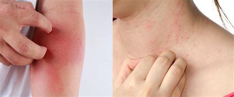 Know More About Inverse Psoriasis Causes And Treatments Of Inverse