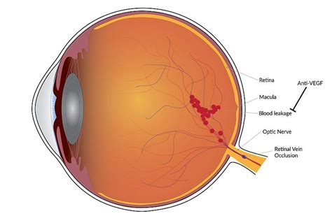 Vision Improvement Is Long Lasting With Treatment For Blinding Blood