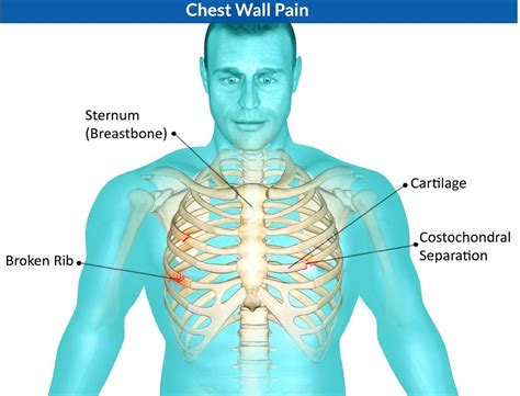 Pin On Costochondritis Treatment