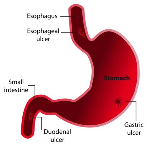 What Is Duodenal Mucosa With Pictures The Best Porn Website
