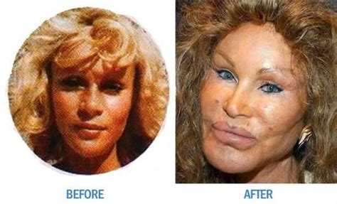Worst Cases Of Botox Ever Girls Celebrities Plastic Surgery