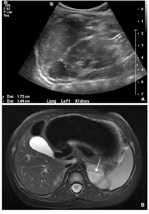 A Renal Ultrasound Image Showing Left Adrenal Mass Measuring 172 9