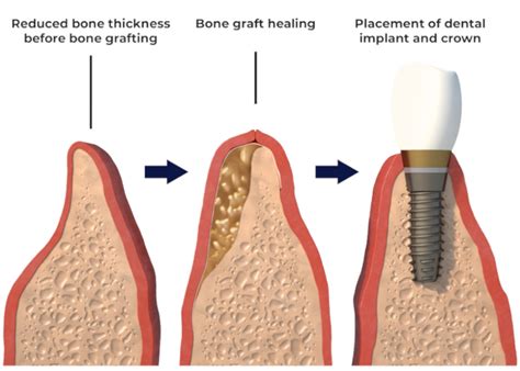 Bone Graft For Dental Implant Explained By A Dentist