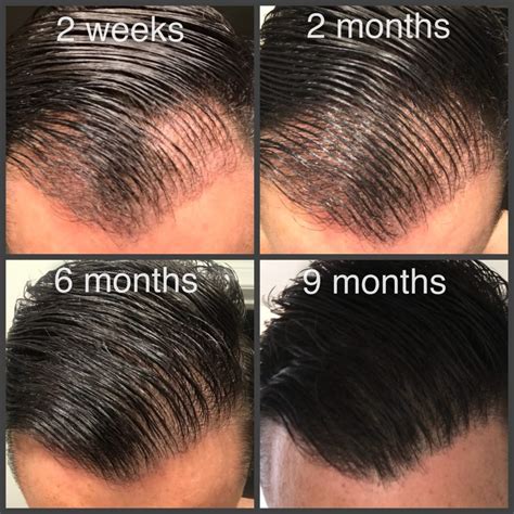 Hair Transplant Timeline Month By Month