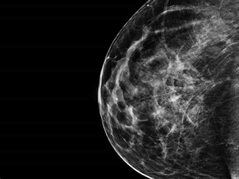 Ballarat To Get 3d Breast Screening Machine To Diagnose Breast Cancer