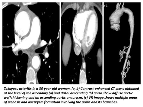 Presentation1 Radiological Imaging Of Thoracic Aortic Aneurysm