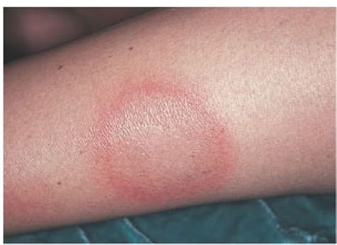 Pin On Health Lyme Ie Borreliosis And Coinfections