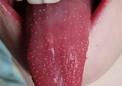 Tongue Bleeding Causes After Brushing Biting Tongue No Reason And