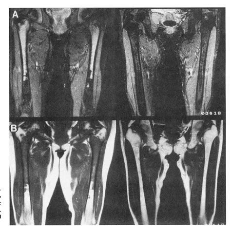Figure 6 From Magnetic Resonance Imaging Of Femoral Marrow In Patients