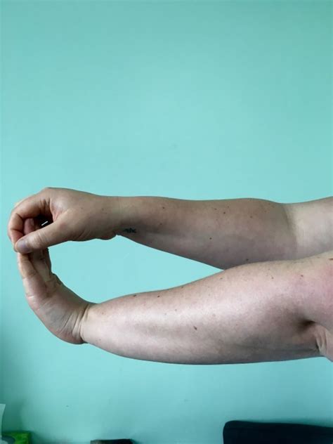 Wrist Flexor Stretch Thorpes Physiotherapy