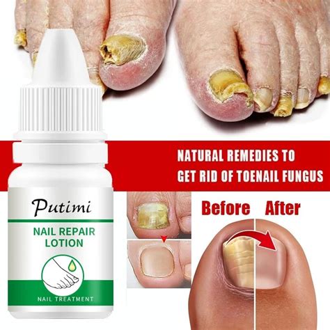 Fungal Nail Treatment Essence Feet Care Serum Anti Infection Paronychia Onychomycosis Nail Foot