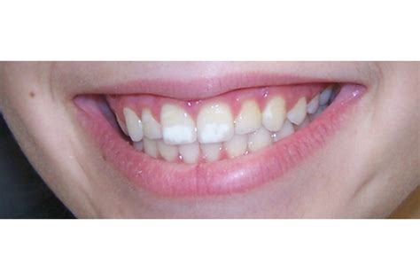 How To Prevent White Spots On Teeth Rowwhole3