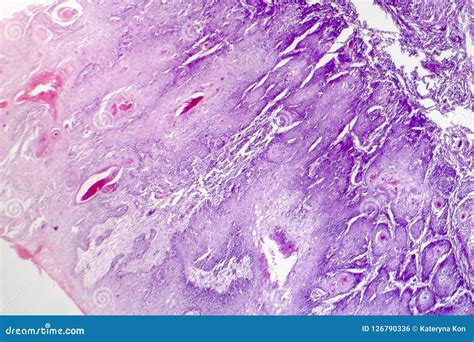 Carcinoma A Cellule Squamose Cutaneo Fotografia Stock Immagine Di