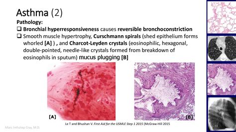 Charcot leyden crystals (clc) are sometime reported in pathological reports of airway or sinonasal samples but their clinical significance remain elusive. Respiratory pathology and pathophysiology global overview ...