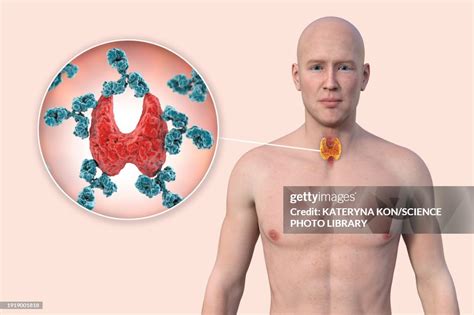 Autoimmune Thyroiditis Illustration High Res Vector Graphic Getty Images