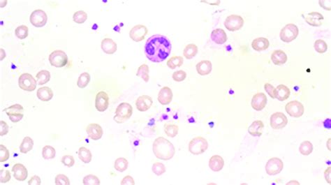 Peripheral Smear Showing Predominantly Normocytic Normochromic Red