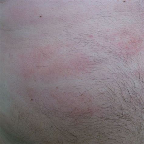 Pictures To Help You Identify Hives Vs Other Skin Rashes Hives