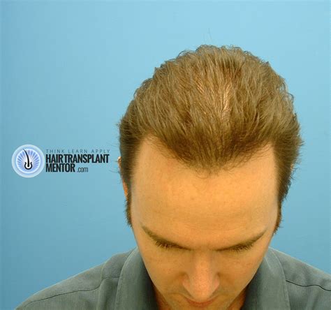 Hair transplants are very popular that the odds you yourself or someone you know has had the procedure are high. Hair Transplant 6 Months Progress