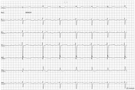 Atrial Flutter With Slow Ventricular Response