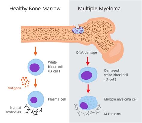 Multiple Myeloma Signs And Symptoms Causes Stages Types Diagnosis And Treatment Options