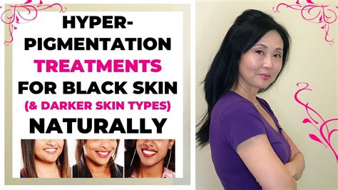 Hyperpigmentation Treatments For Black Skin And Darker Skin Types