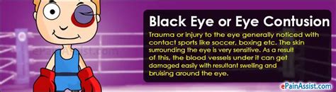 Black Eye Or Eye Contusiontreatmentcausessymptoms