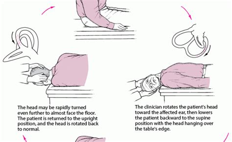 Epley Maneuver For Treatment Of Vertigo Right Sided Bppv Treatment