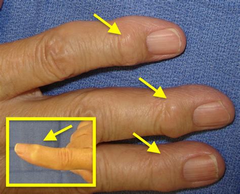 Osteoarthritis Nodules On Fingers