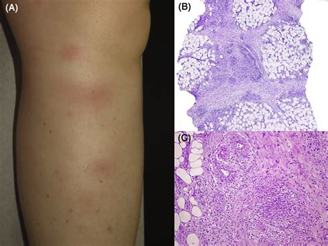A Tender Subcutaneous Nodules Symmetrically Involving The Patients
